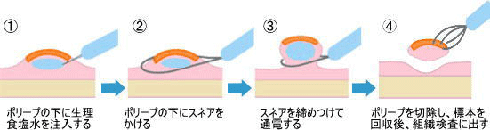 経口内視鏡検査について